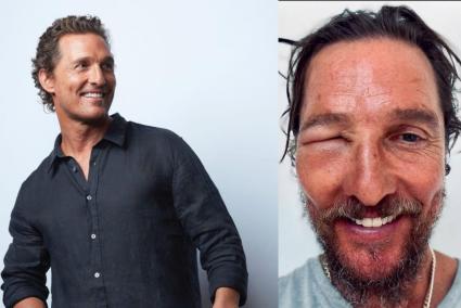 Matthew McConaughey, con la cara desfigurada tras la picadura de una abeja